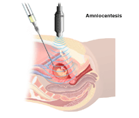Illustration demonstrating  an amniocentesis