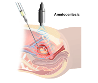Dibujo que demuestra la amniocentesis