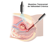 Dibujo que demuestra el muestreo transcervical de la vellosidad coriónica